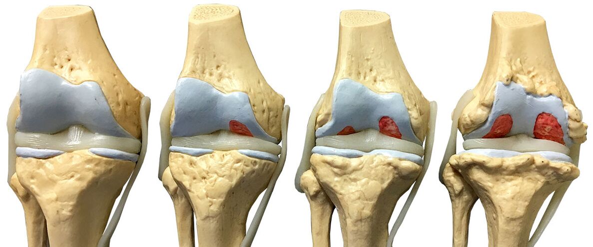 Stages of arthrosis of knee combination