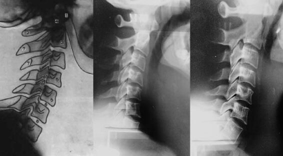Neck with a displacement of first cervical vertebra
