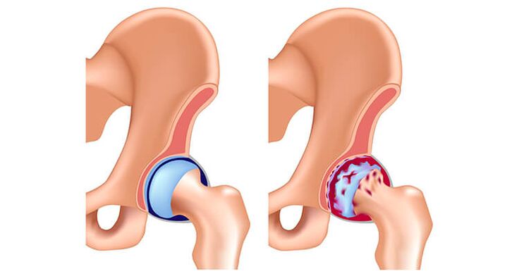 Artrosis of hip joint