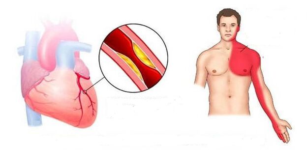 Karik syndrome